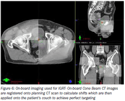 Image Guided Radiation Therapy IGRT AARO SG