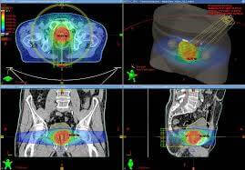 Radiation Therapy | AARO Singapore Stereotactic Radiosurgery