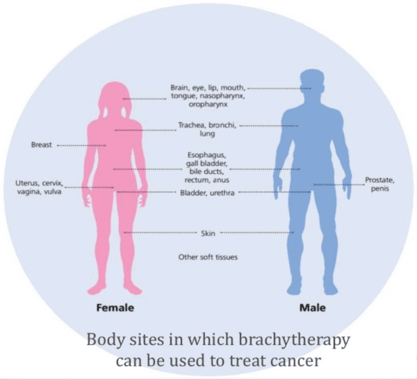 Brachytherapy Asian Alliance Radiation & Oncology (AARO)