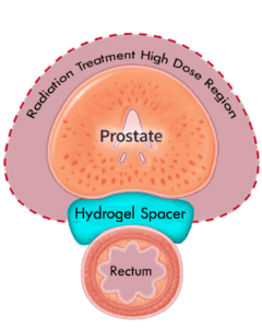 Spaceoar Hydrogel Prostate Cancer Treatment Aaro Sg
